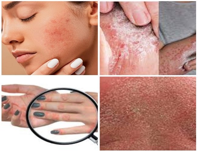 त्वचा रोग सोरायसिस (Psoriasis)
